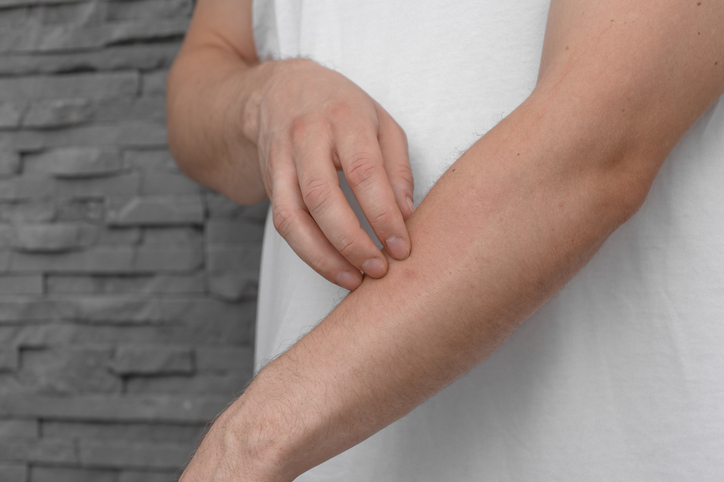 Man scratches his hand, itchy hives